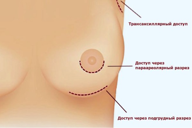 Редукционная маммопластика или операция по уменьшению груди - Estmedica
