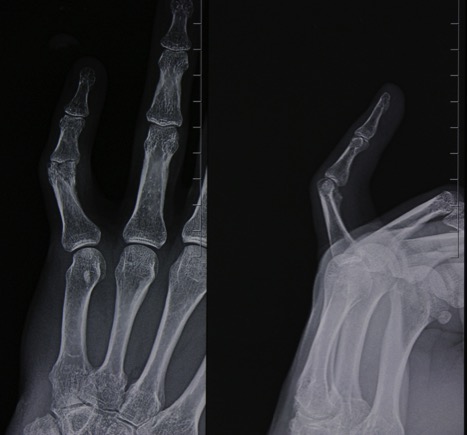 Трещина фаланги. Перелом основания основной фаланги 4 пальца. Перелом 3 фаланги среднего пальца правой руки рентген. Закрытый краевой перелом основания основной фаланги 5 пальца. Перелом основания основной фаланги 1 пальца.