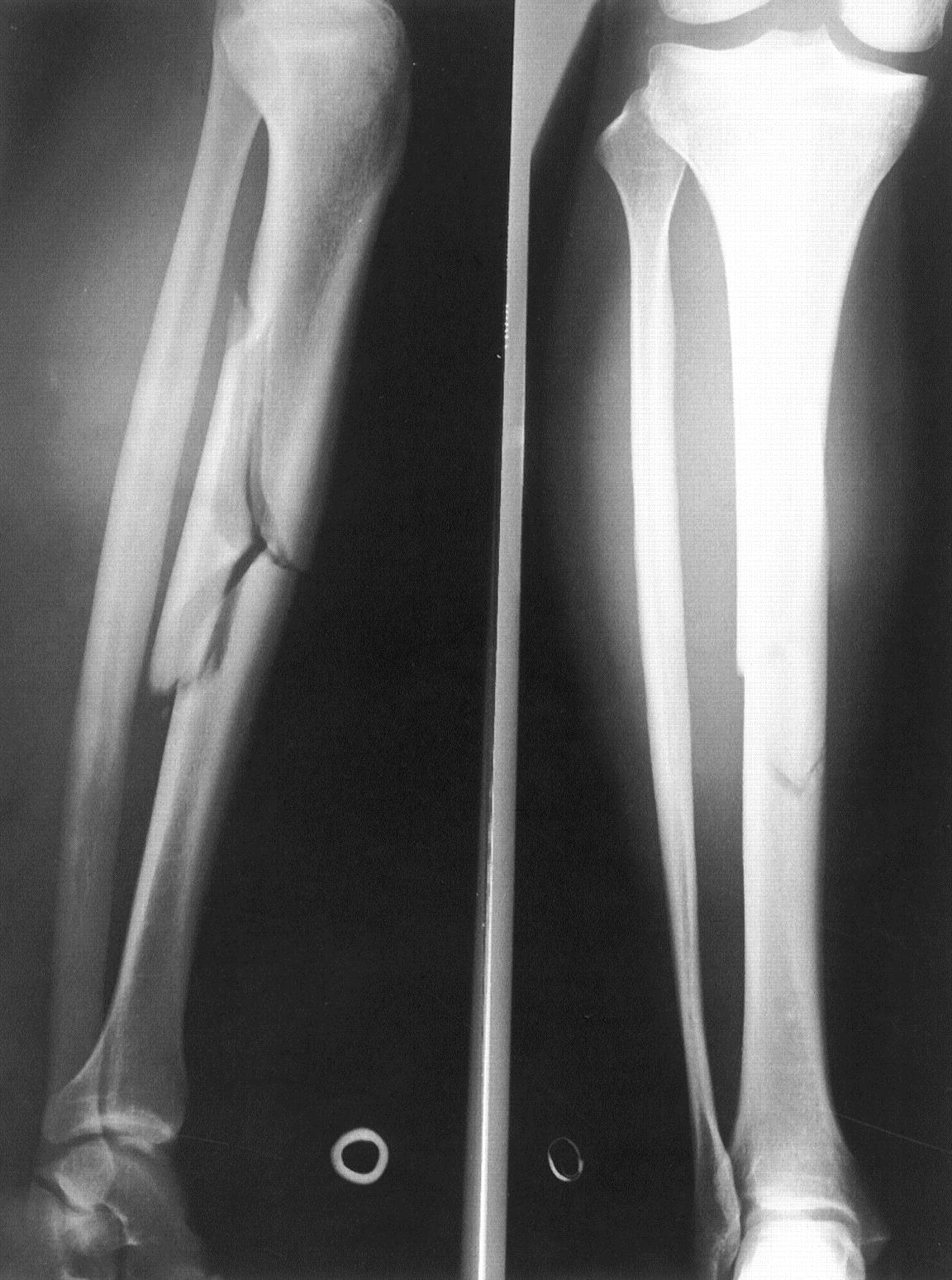 Переломы костей голени - Клиника 29