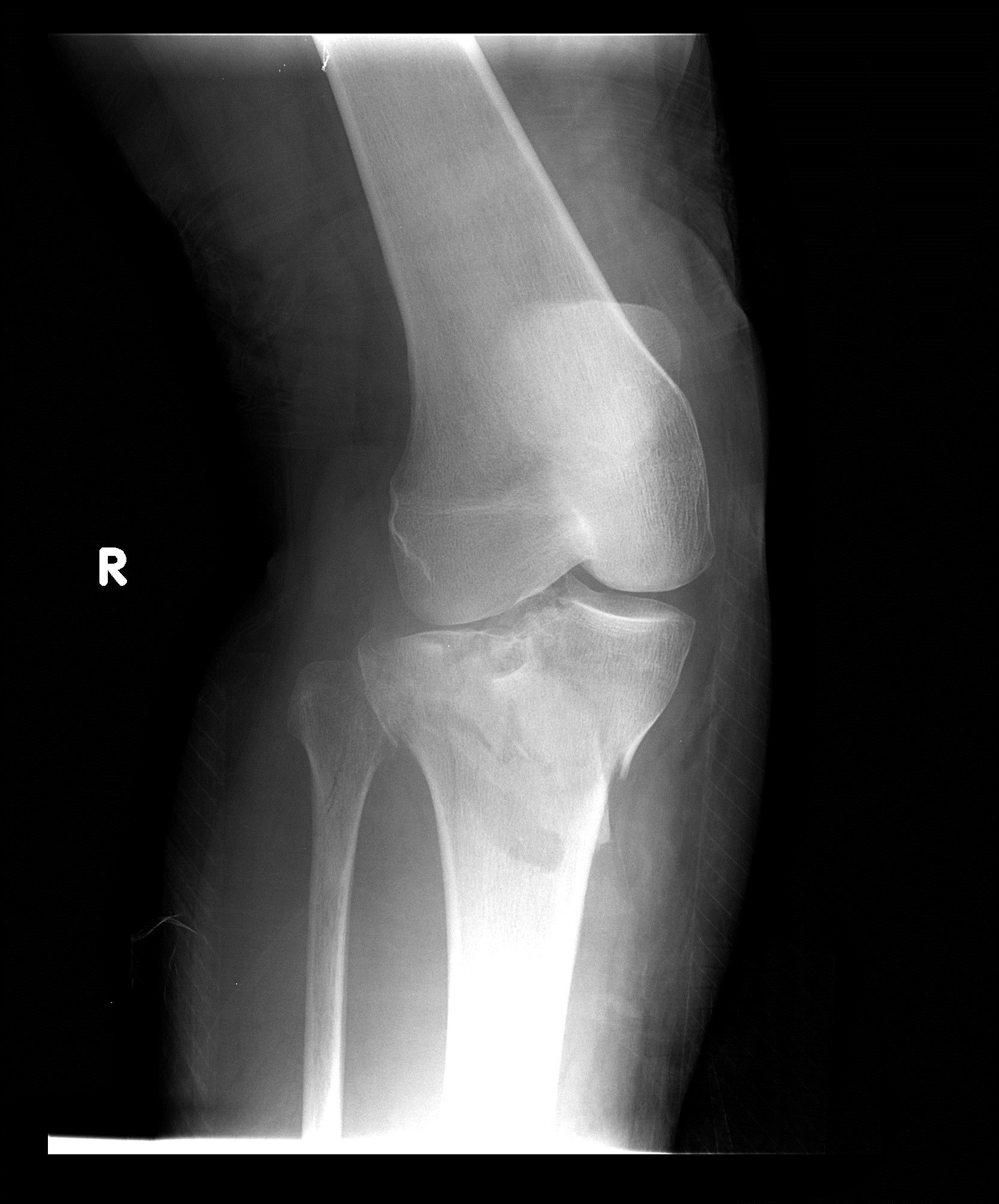 6 недель перелом. Перелом плато большеберцовой кости. Перелом большой берцовой кости в коленном суставе. Перелом малоберцовой кости. Перелом малоберцовой кости рентген.